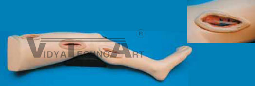 Endovascular Leg